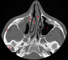*they are separated from each other by a septum. Paranasal Sinuses Ct Anatomy W Radiology