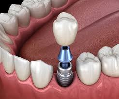 More news for how dental implants work » Dental Implants Ellicott City Md Missing Teeth Dentures