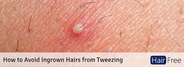 Anyone can get an ingrown hair. How To Avoid Ingrown Hairs From Tweezing Hair Free Life