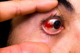 Show it off on social media. Red Eyes List Of Common Causes