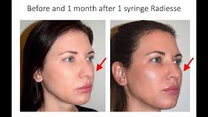 Alibaba.com offers 818 hyaluronic acid gel injections filler contouring face products. Facial Contouring And Cheek Enhancement With Dermal Fillers Radiesse Dr David P Rapaport Nyc Youtube