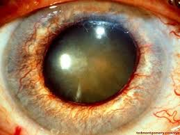 Pin On Ocular Pathophysiology