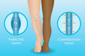 How Wearing Compression Stockings Can Help Your Varicose Veins Vein Health Clinic Melbourne