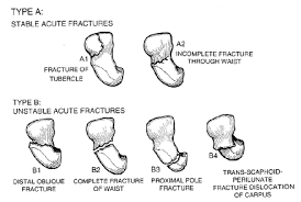 Der tfcc (triangulärer fibrokartilaginäre komplex) bezeichnet eine knorpelartige struktur, die sich im handgelenk befindet. Https Campus Nes De Fileadmin User Upload Rad Vortrag Hand Dtsch Roentgenkongress 2005 Cms 2 Pdf