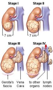 Kidney Cancer