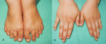 Image result for Koilonychia feet