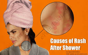 Causes Of Rash After Shower Rash Causes Rashes What Causes Rashes