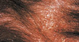 Zur behandlung von pilzerkrankungen (mykosen) der haut und schleimhaut, verursacht durch dermatophyten, hefen, schimmelpilze und andere, wie malassezia furfur, sowie hautinfektionen durch corynebacterium minutissimum. Kopfschuppen Kleienpilzflechte Pityriasis Versicolor Ratgeber Fur Patienten Mit Juckreiz Und Rotungen Seborrhoische Dermatitis Pdf Kostenfreier Download