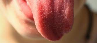 Blaschen Auf Der Zunge Hilfe Ursachen Fur Aphten Blaschen Usw