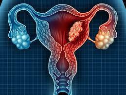Bleeding indicates cancer only in a small percentage of cases, even though endometrial cancers are on the rise in american women. Postmenopausal Bleeding Should Prompt Endometrial Ca Evaluation Medpage Today