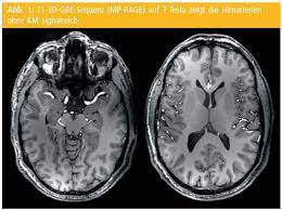 Ultrahochfeld Mrt 7 Tesla Bei Neurologischen Fragestellungen Und Technische Weiterentwicklungen Medmedia