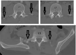 We did not find results for: Transverse Process Fractures A Clinical Series And Coronal Injury Of The Spine Sciencedirect