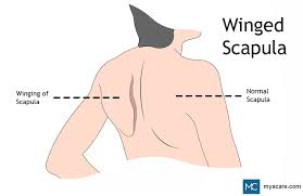 Image result for Winged Scapula