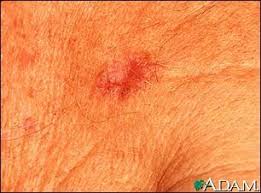 Learn about skin cancer, including basal cell carcinoma, melanoma and squamous cell carcinoma. Pin On Squamous Cell Carcinoma