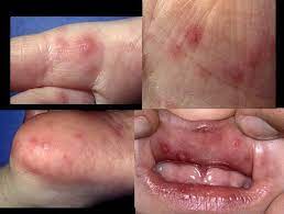 Se caracterizeaza prin eruptii veziculare la nivelul tegumentului gurii, dar si pe maini (palme) sau picioare (talpi). Voceaconstantei Ro Boala ManÄƒ GurÄƒ Picior Intre Pericol È™i PrevenÈ›ie