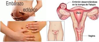 Sintomas Del Embarazo Ectopico Causas Signos Diagnostico Tratamiento Y Panorama Arriba Salud