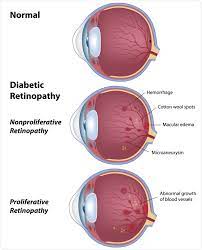 Healthy people 2020 sets national objectives to improve eye health and uses data to track progress toward these goals. Diabetic Eye Disease Diabetic Retinopathy Stages