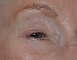 More than half of merkel cell carcinomas (mccs) occur in the head and neck of elderly people, in areas of actinically damaged skin. Merkel Cell Carcinoma Of The Eyelid