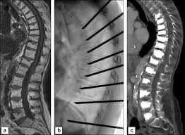 We did not find results for: Techniques De Consolidation Osseuse Guidee Par Imagerie En Oncologie Cimentoplastie Et Vissage Sciencedirect