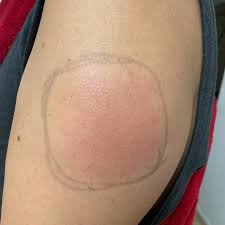 Some people see their skin swell and turn red or dark blue. Covid Arm Rash After Moderna Vaccine Is Itchy But No Big Deal