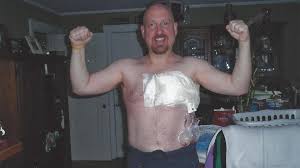 The main symptom of male breast cancer is a lump in the breast area. Man Who Faced Breast Cancer Scare Shares His Story It Can Happen To Us Too