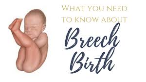Image result for Breech Delivery