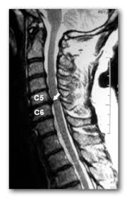 Hernia de disc poate apare in orice parte a coloanei vertebrale, de cele mai multe ori la nivelul inferior al coloanei (zona lombara). Hernia De Disc Lombara Gradul 2 Move Flex Gel In Romania