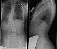 Pin By Christian Lewin On Scoliosis Scoliosis Scoliosis Exercises Shiatsu Massage