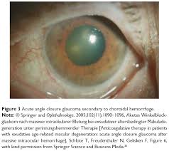 Glaucoma is a group of eye diseases characterized by damage to the optic nerve usually due to. Full Text The Early History Of Glaucoma The Glaucous Eye 800 Bc To 1050 A Opth