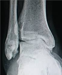Image result for Ankle XRay