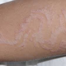 There was no reaction at the vinegar site (fig. Pdf Henna Tattoo Contact Dermatitis A Report Of Four Cases And Brief Review Of The Selected Literature