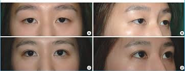 Figure 3 from Cosmetic Lateral Canthoplasty: Lateral Canthoplasty to  Lengthen the Lateral Canthal Angle and Correct the Outer Tail of the Eye