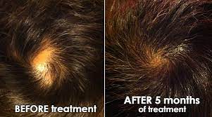221 patients with herpes zoster have undergone the treatment. Murray Avenue Apothecary Hair Loss