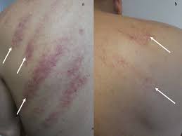 • an abnormality in the factors • some major categories of blood diseases that feature purpura include such as platelet disorders, and. Cureus New Onset Of Linear Purpura On The Back Coining Therapy Associated Ecchymoses
