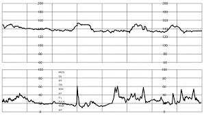 Image result for Structured Intermittent Auscultation