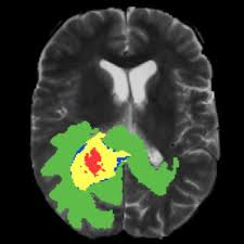 Knowing these factors can help you identify your risk and potential symptoms, and get regular checkups. Brain Tumor Segmentation Papers With Code
