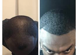 Black african hair transplant before & after hairline restoration surgery result by dr. Mens Hair Transplant Cost Harley Street Healthcarehair Transplant Clinic In London Manchester Birmingham Uk