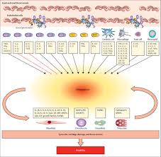 Jan 25, 2021 · psoriatic arthritis shares many symptoms with several other arthritic conditions, such as ankylosing spondylitis, reactive arthritis, and arthritis associated with crohn's disease and ulcerative colitis. The Pathogenesis Of Psoriatic Arthritis The Lancet