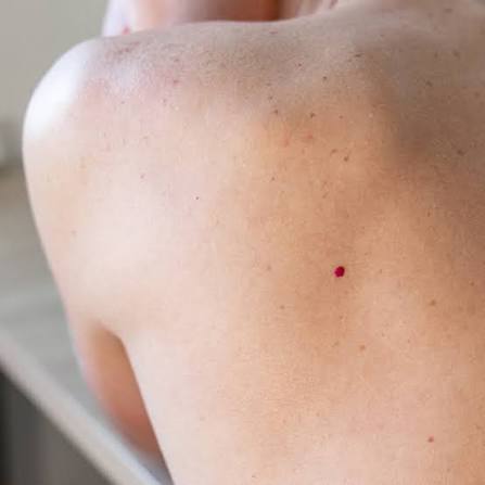 What Types of Skin Lesion Removal Are Available?
