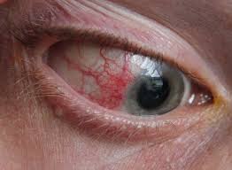 Image result for lesion sclera
