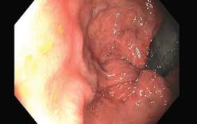 Depending on the size and location of the hemorrhoid, your. Hemorrhoid Disease And The Role Of The Gastroenterologist Gastroenterology Endoscopy News