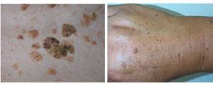 Modermærke ru overflade / tusindvis af nye billeder hver dag helt gratis at bruge videoer og billeder fra pexels i høj kvalitet. Heksevorter Og Andre Gevaekster Co2 Laser Hudsygdomme Akne Psoriasis Eksem Hudkraeft Solskader Rynker Molholm