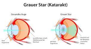 Grauer Star Katarakt Kunstlinse Augenlinsentrubung