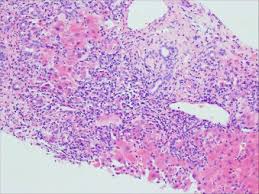 Well, it's an autoimmune disease that affects the liver, leading to inflammation and hepatitis. Autoimmune Hepatitis Sciencedirect
