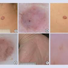 Possible signs and symptoms of melanoma. Pdf Update On Non Melanoma Skin Cancer And The Value Of Dermoscopy In Its Diagnosis And Treatment Monitoring