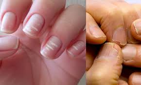 Baixe agora mesmo a foto fungo na unha e dermatite. 10 Sinais De Alerta Que Suas Unhas Podem Mostrar Segredos Do Mundo