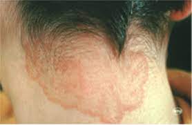Hand sanitizers labeled as containing the term alcohol, used by itself, are expected to contain ethanol. Ringworm Dermatologist In Winter Haven Winter Haven Dermatology