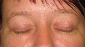 Image result for xanthelasma of eyelid