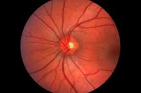 Image result for Glaucoma
