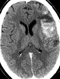 However, for a definitive diagnosis, ct or mri is needed. Ct Protocol For Acute Stroke Tips And Tricks For General Radiologists Radiographics